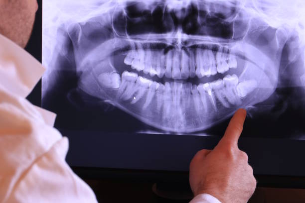 Best Knocked-Out Tooth (Avulsed Tooth) Treatment in Ashton Sandy Spring, MD